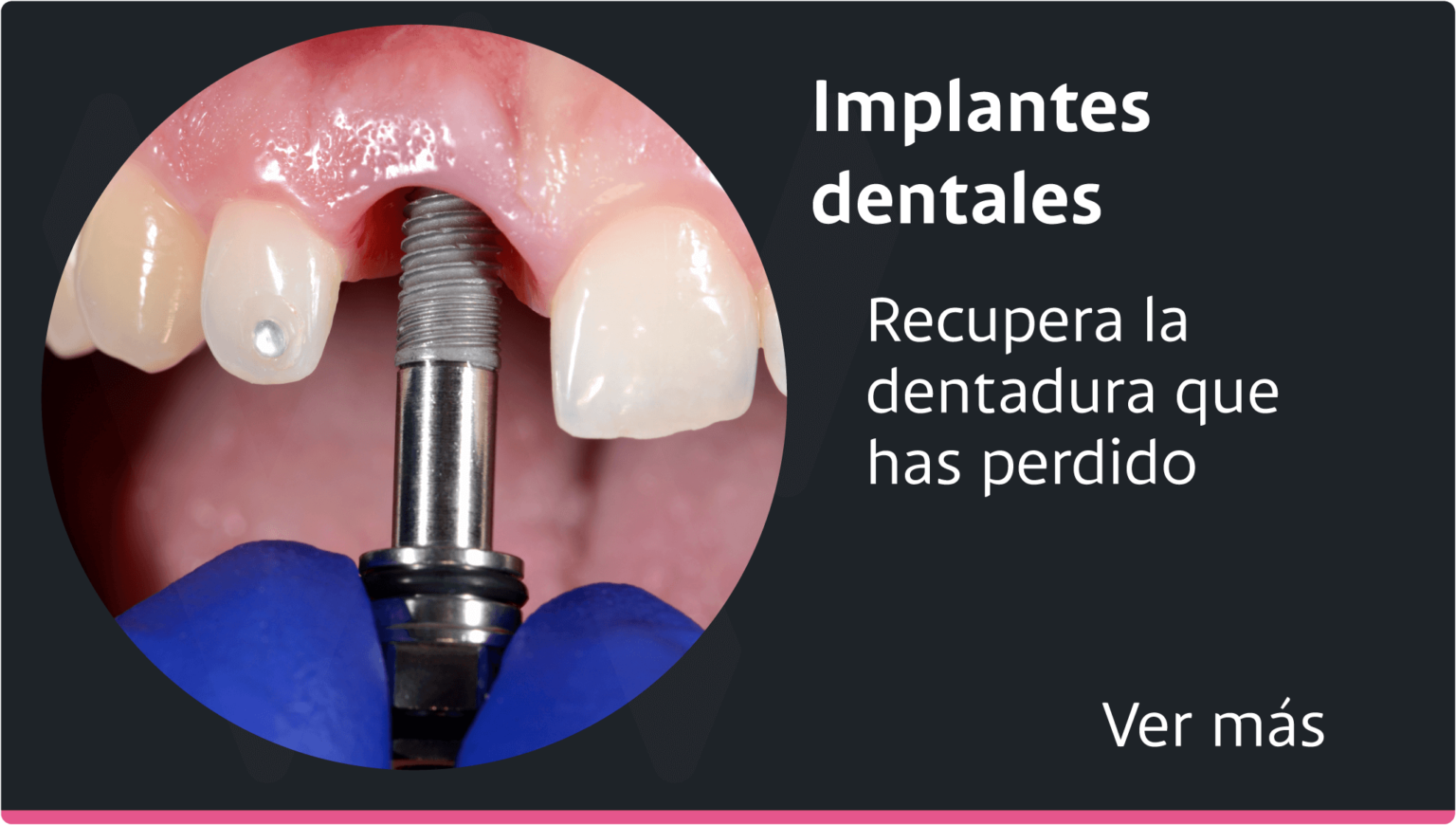 Implante-dental