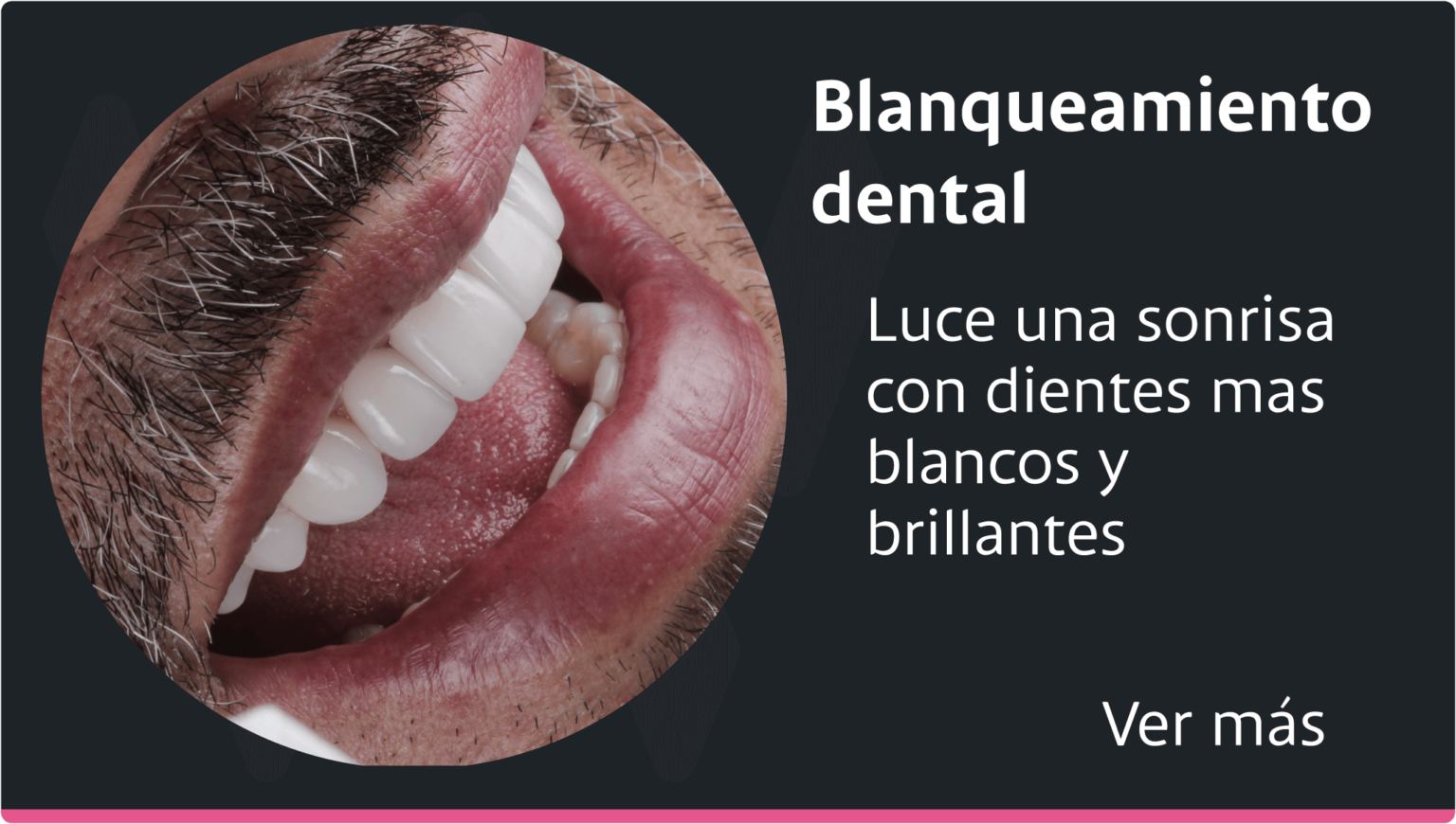 blanqueamiento-dental