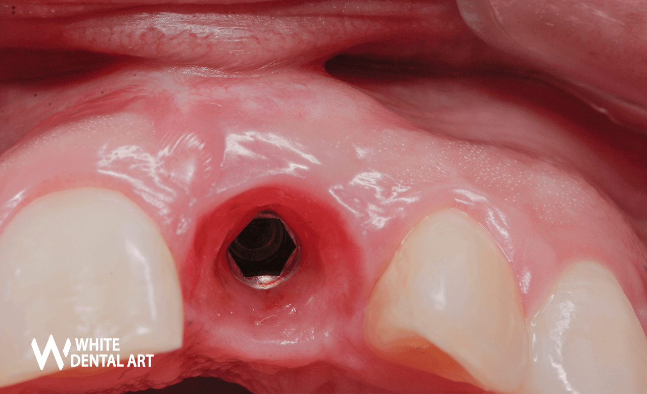 implantes-sonrisa-blanca-tratamiento-blanqueamiento-denta10