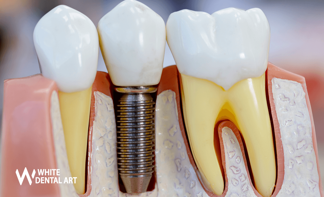 implantes-sonrisa-blanca-tratamiento-blanqueamiento-denta11