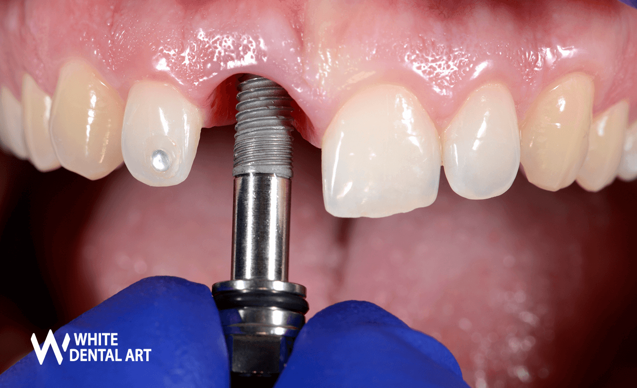 implantes-sonrisa-blanca-tratamiento-blanqueamiento-denta12