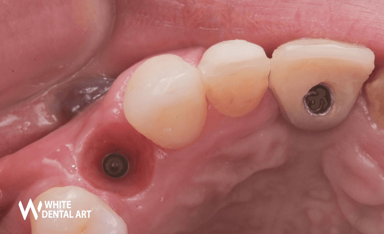 implantes-sonrisa-blanca-tratamiento-blanqueamiento-denta3