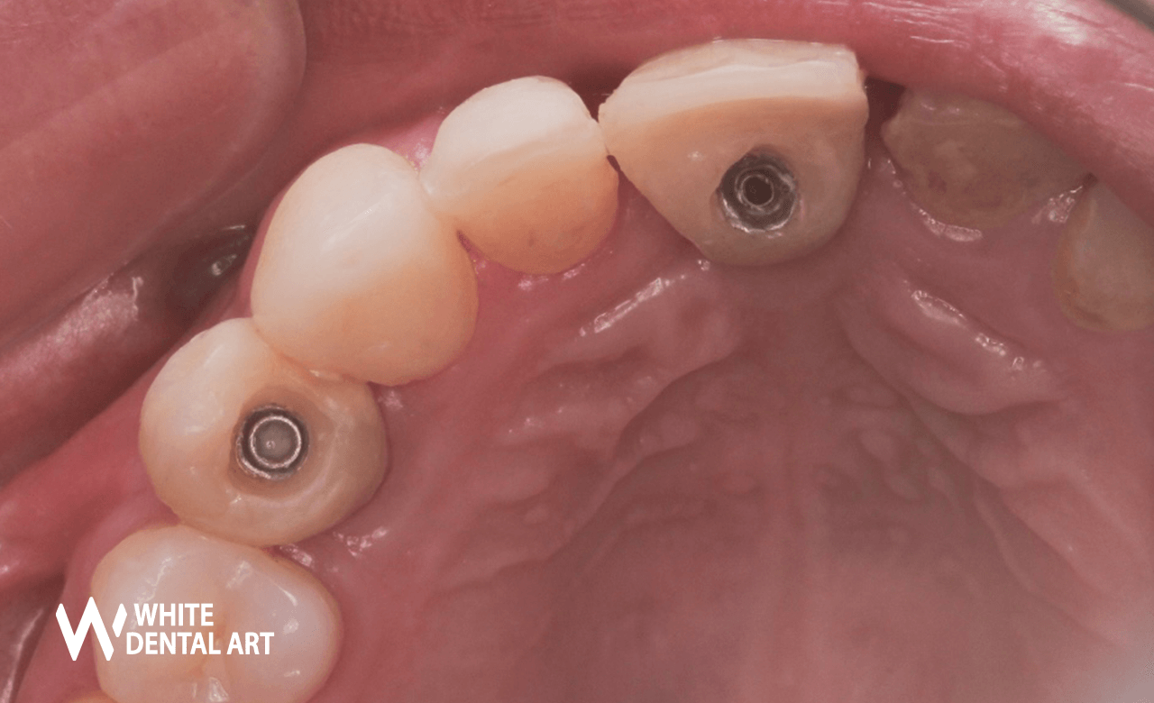 implantes-sonrisa-blanca-tratamiento-blanqueamiento-denta4