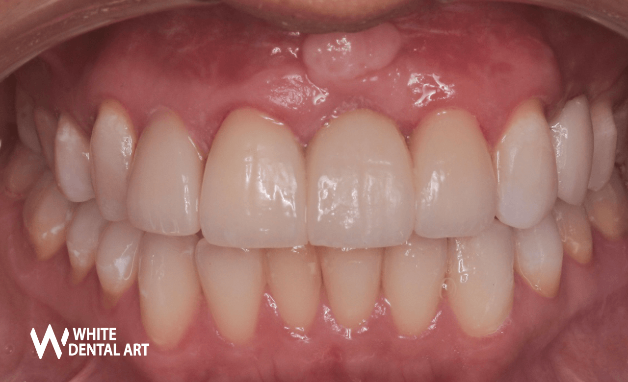 implantes-sonrisa-blanca-tratamiento-blanqueamiento-denta5