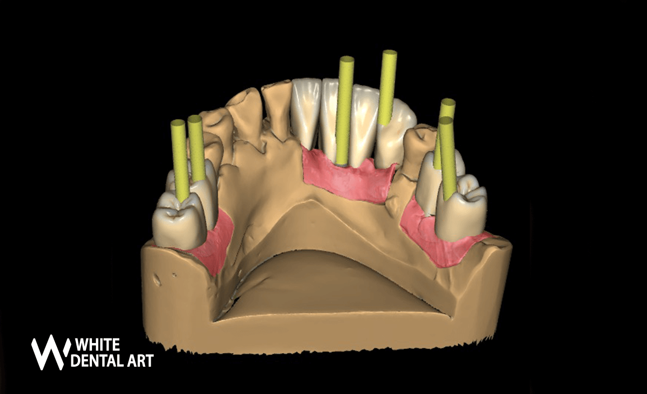 implantes-sonrisa-blanca-tratamiento-blanqueamiento-denta7