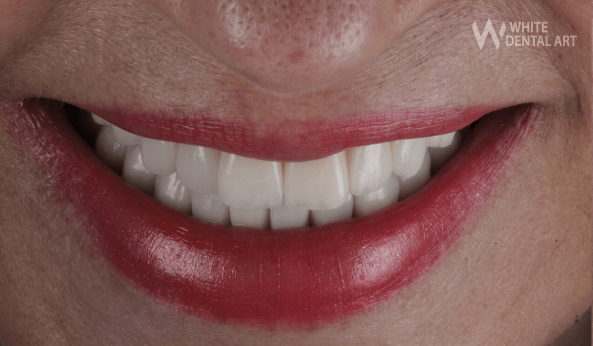 sonrisa-blanca-tratamiento-blanqueamiento-dental1