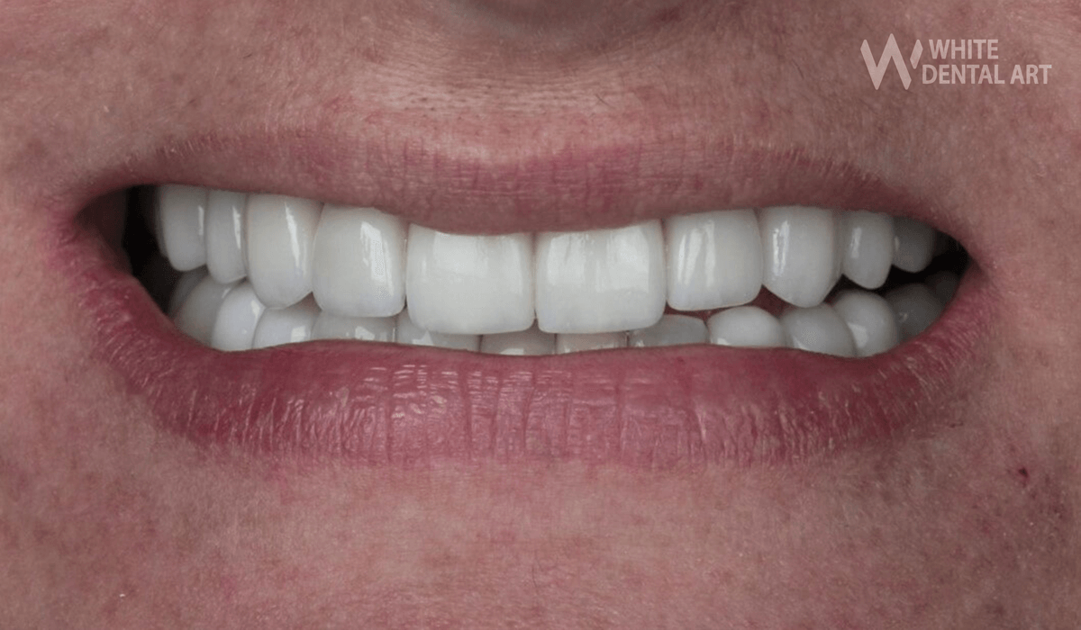 sonrisa-blanca-tratamiento-blanqueamiento-dental2