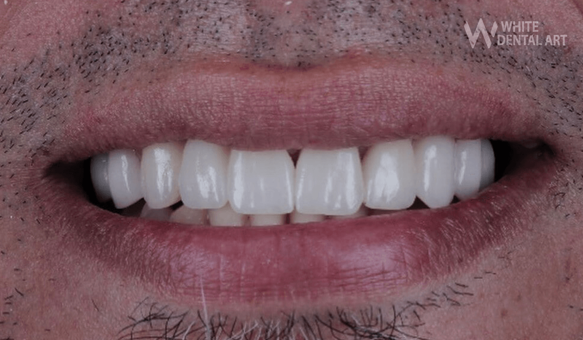 sonrisa-blanca-tratamiento-blanqueamiento-dental3