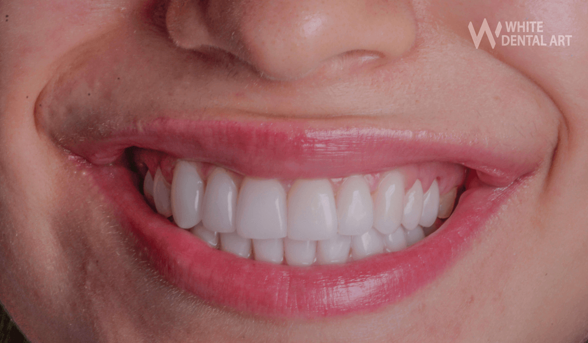 sonrisa-blanca-tratamiento-blanqueamiento-dental4