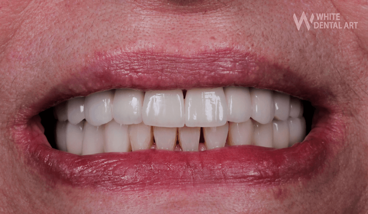 sonrisa-blanca-tratamiento-blanqueamiento-dental5